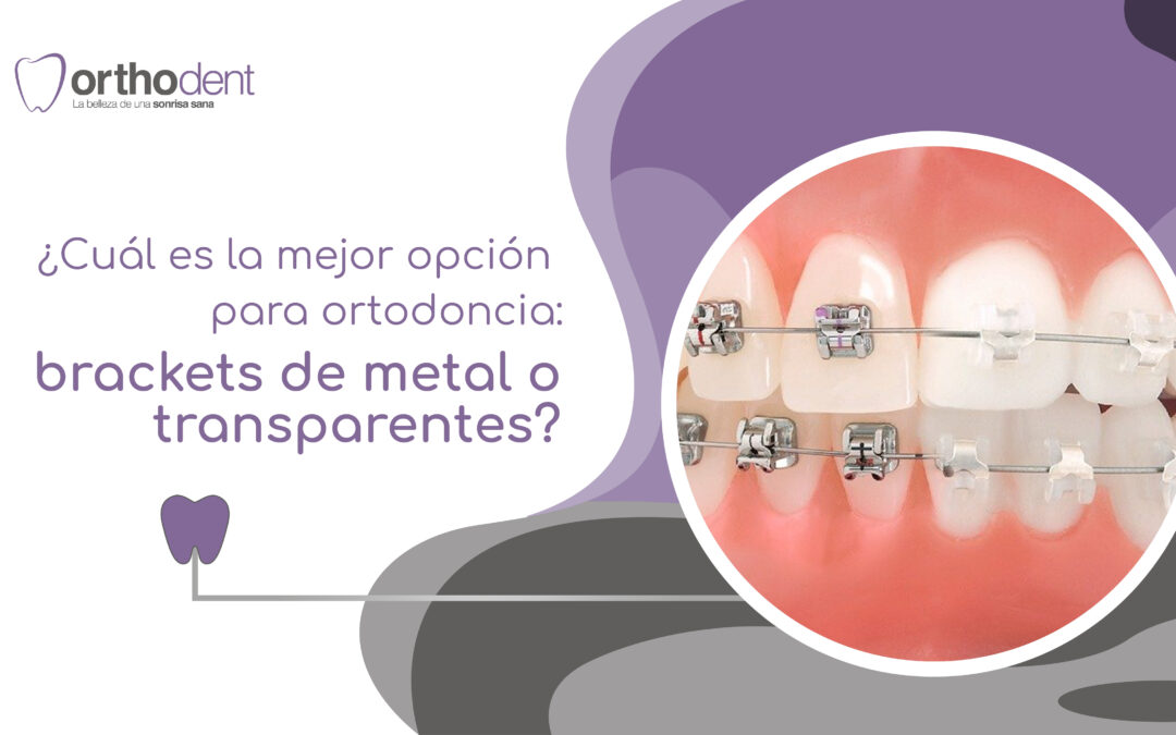 ¿Cuál es la mejor opción para ortodoncia: brackets de metal o transparentes?