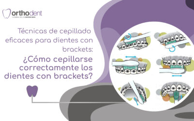 Técnicas de cepillado eficaces para dientes con brackets: ¿Cómo cepillarse correctamente los dientes con brackets?