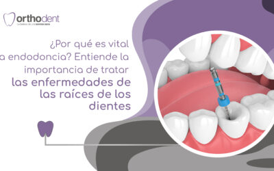 ¿Por qué es vital la endodoncia? Entiende la importancia de tratar las enfermedades de las raíces de los dientes