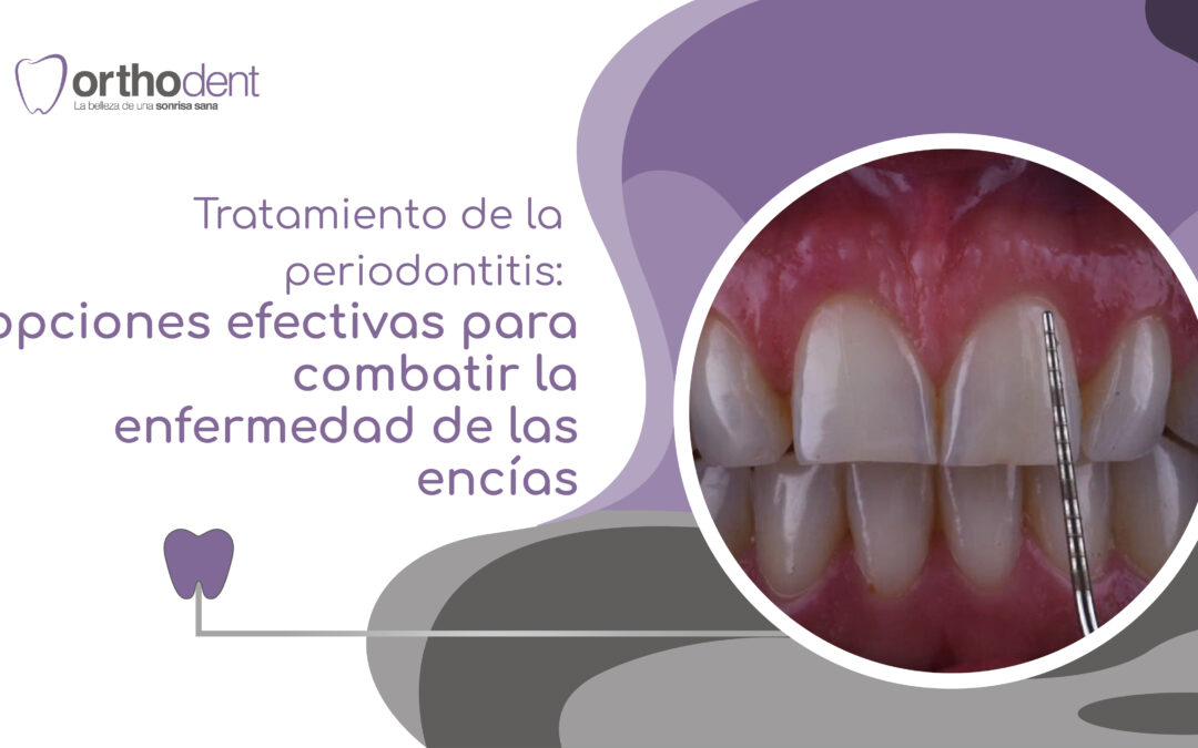 Tratamiento de la periodontitis opciones efectivas para combatir la enfermedad de las encias