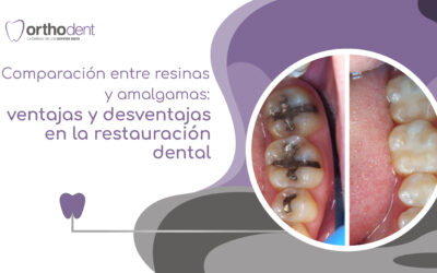 Comparación entre resinas y amalgamas: ventajas y desventajas en la restauración dental