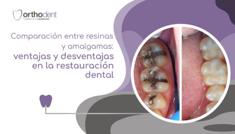 Comparación entre resinas y amalgamas ventajas y desventajas en la restauración dental Orthodent